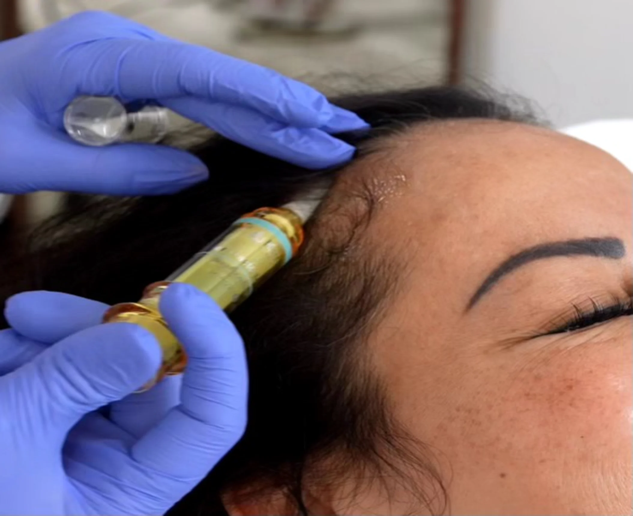 A close-up of a woman receiving a hair restoration treatment, with a syringe applying solution near her hairline A close-up of a woman receiving a hair restoration treatment, with a syringe applying solution near her hairline